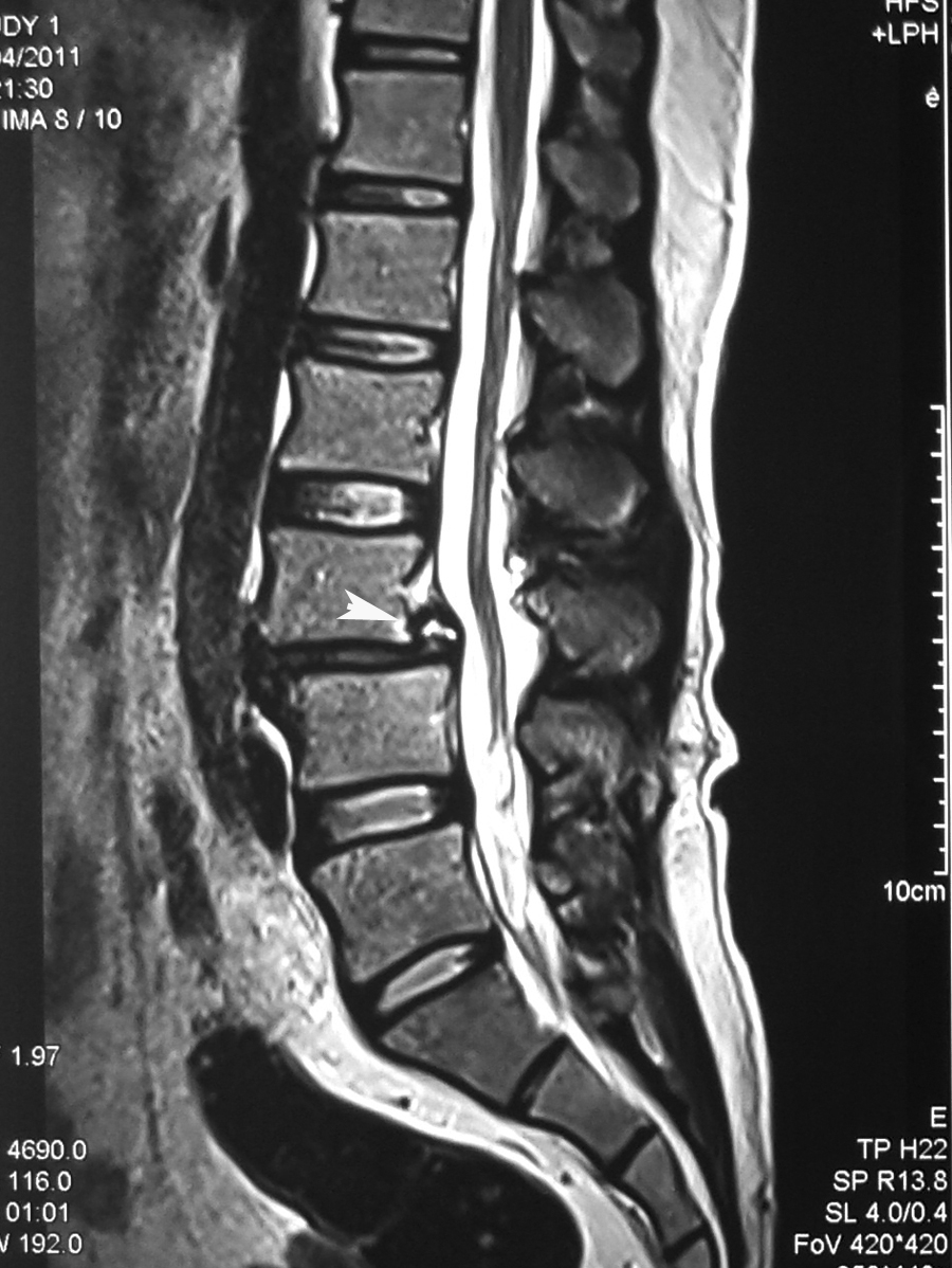 grade 1 retrolisthesis l3 Retrolisthesis is the posterior displacement of one vertebral body with respect to the adjacent vertebrae, to a degree less than a dislocation. grade 1 retrolisthesis l3 Retrolisthesis is the posterior displacement of one vertebral body with respect to the adjacent vertebrae, to a degree less than a dislocation.