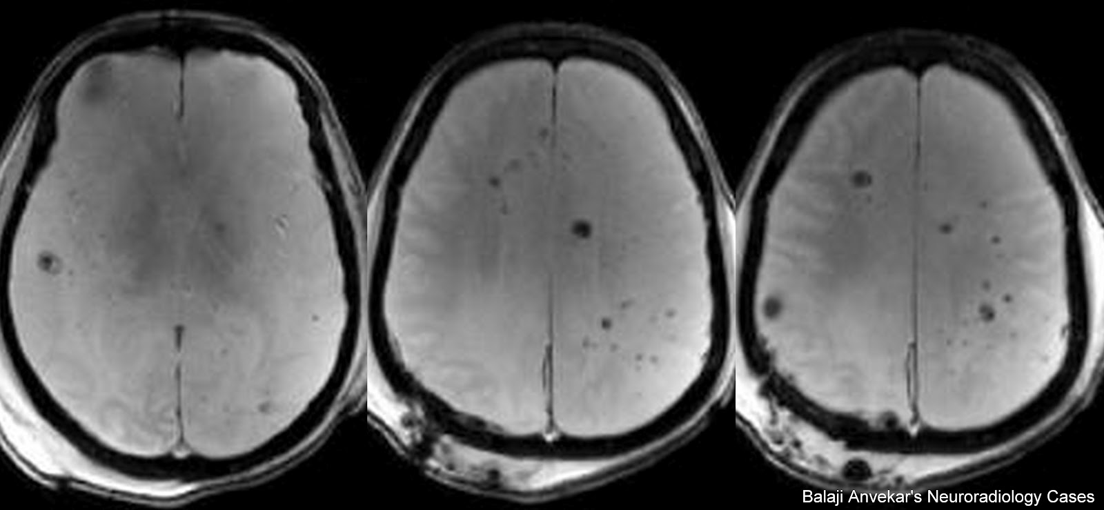 Brain Capillary Telangiectasia