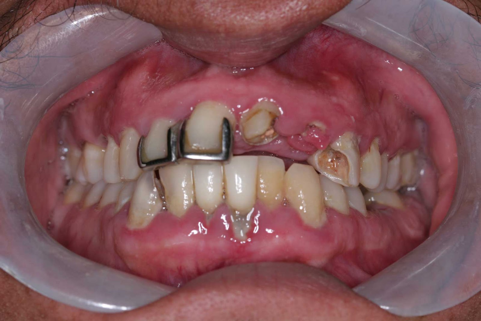 calculus bridge dental