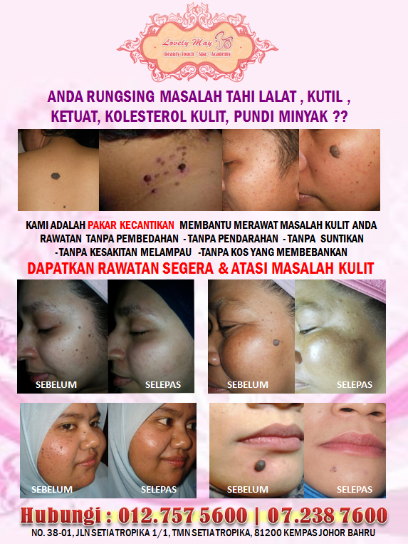 NAK BUANG TAHI LALAT, KUTIL, PUNDI MINYAK dll ?