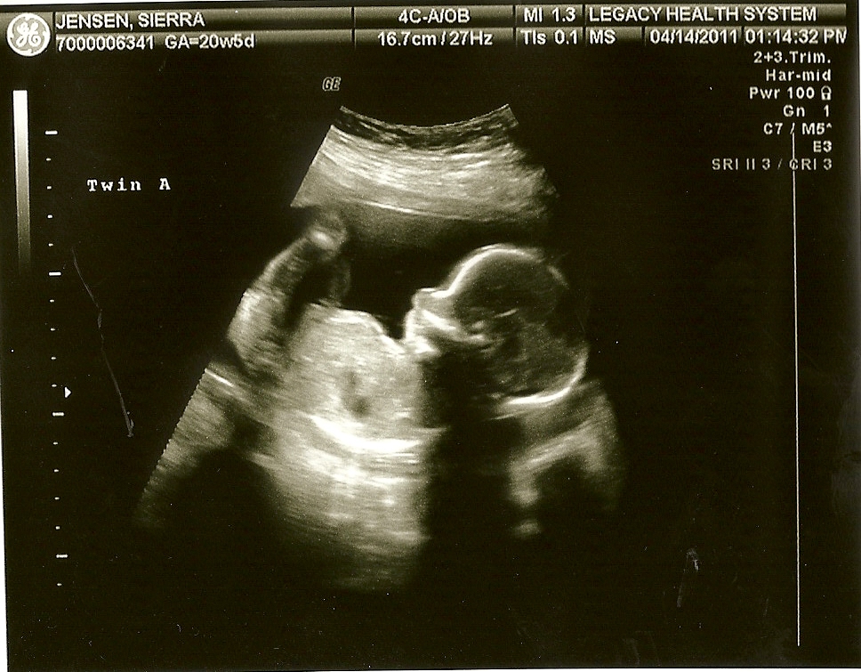 The Jensen Family: 20 Weeks Ultrasound