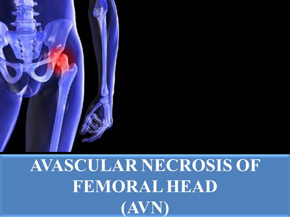 ORTHOPEDIC DOCTOR AVASCULAR NECROSIS OF FEMORAL HEAD