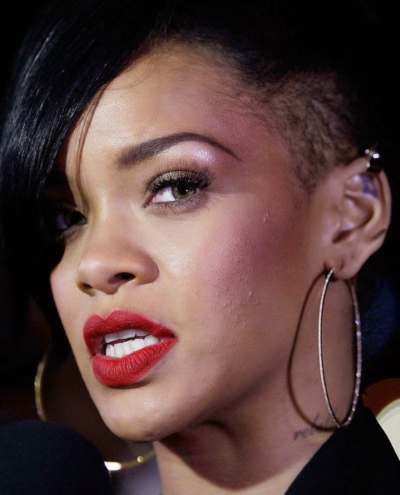 Rihanna Acne Image Acne Picture
