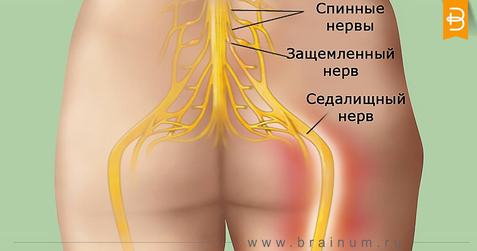 Защемление нерва в спине: лечение в домашних условиях 81 Защемление нерва в спине: лечение в домашних условиях 8