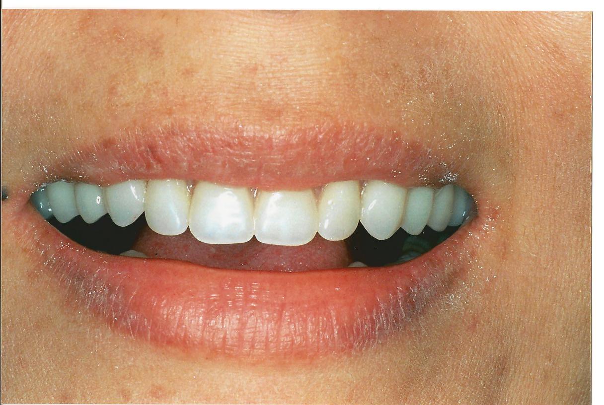 Ask Dr. Spindel Can a denture look natural?