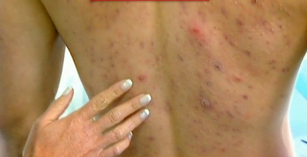 obat sipilis atau raja singa obat sipilis, obat penyakit sipilis, obat raja singa, obat penyakit raja singa, sipilis atau raja singa