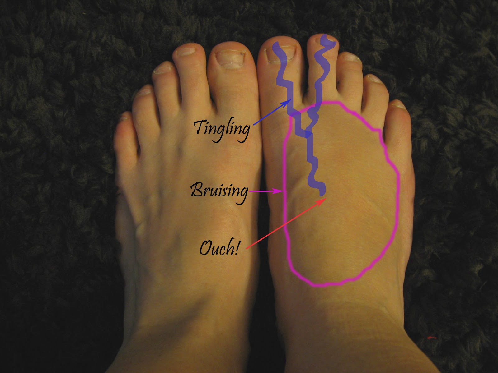 Painful Feet & Arch Supports - HangSchusterman's blog