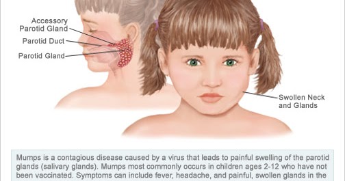 Mumps Causes, Symptoms and Treatment diagram of infected salivary glands 