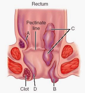 Pectinate Line Hemroid