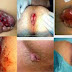 Obat Wasir Wanita thumbnail