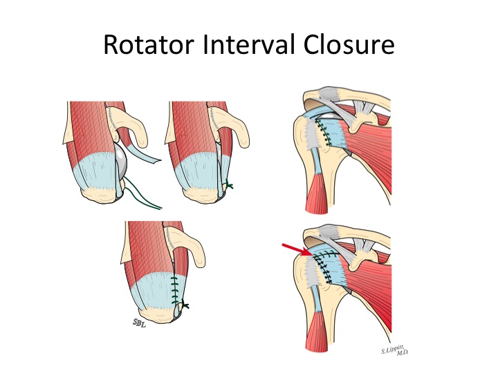 Shoulder Arthritis / Rotator Cuff Tears causes of shoulder pain A