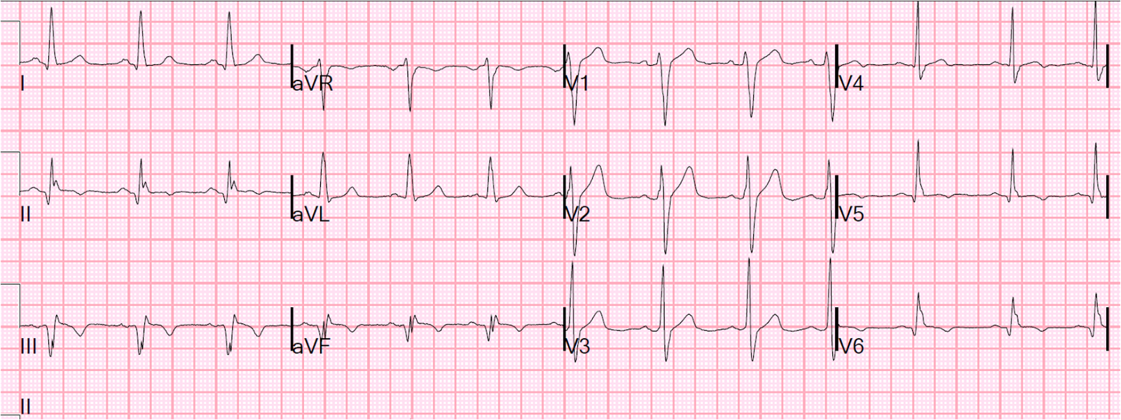 Nonspecific intraventricular conduction delay (defect) – ECG & ECHO