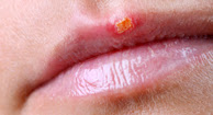Picture of Canker Sore