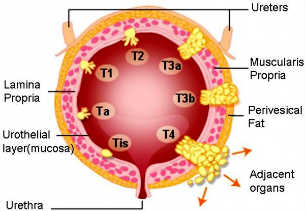 Types of Cancer, Cancer8