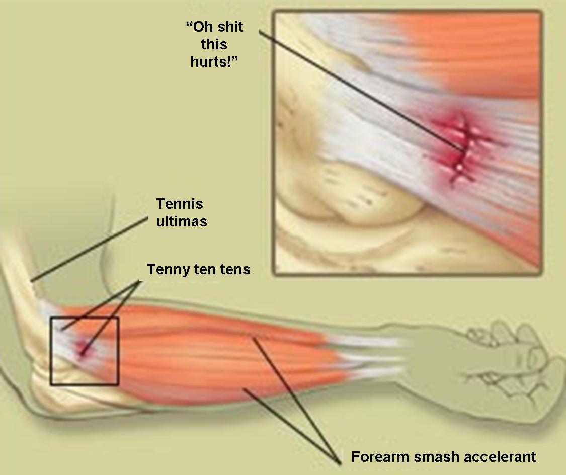 Strength Training Tennis Elbow : Tennis Elbow Secrets Revealed Aids You With How To Cure Nagging Tennis Elbow In Your House
