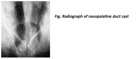 Nasopalatine duct cyst (incisive canal cyst) 2 Nasopalatine duct cyst (incisive canal cyst)