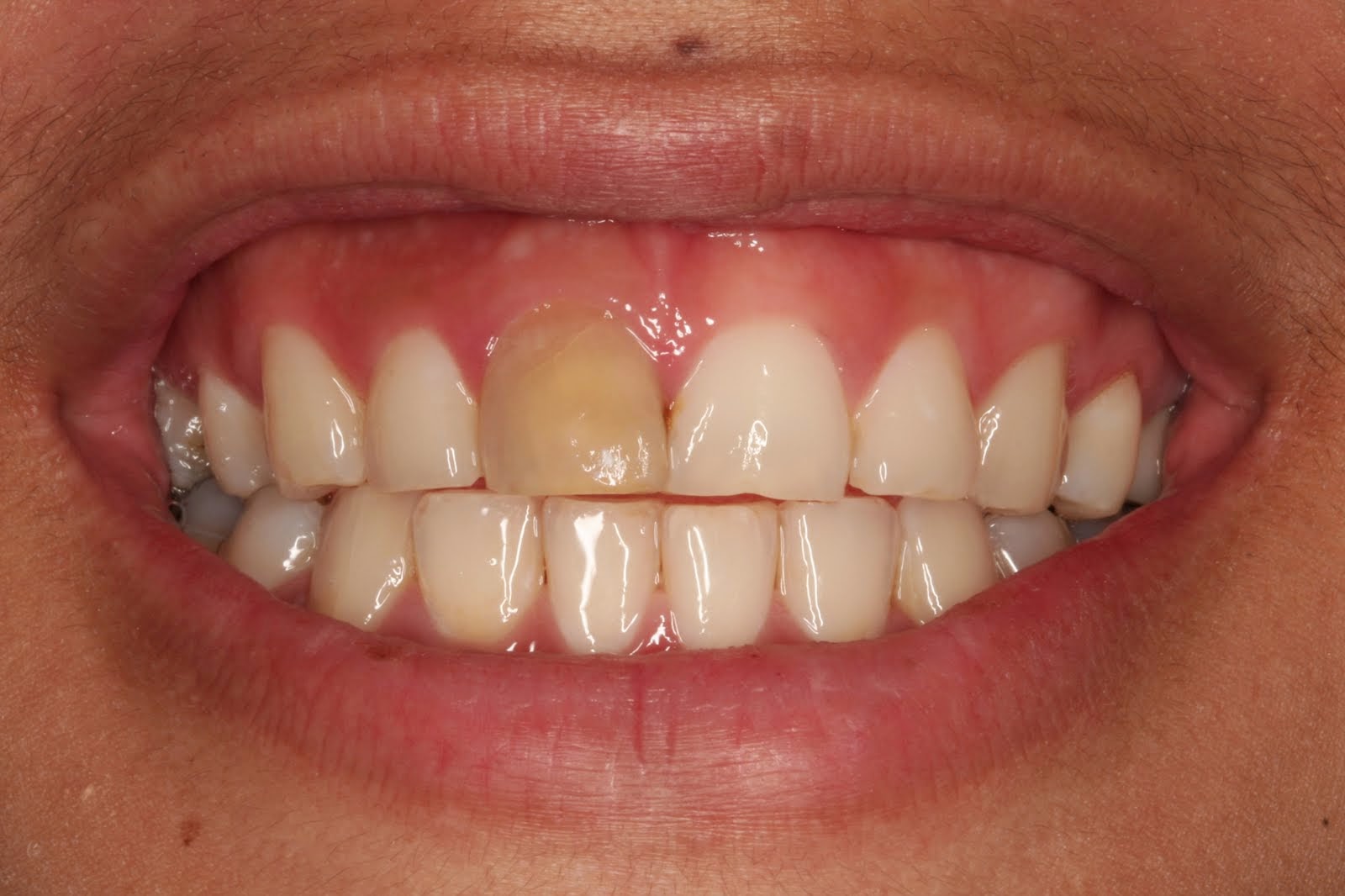 RCT Endodontics