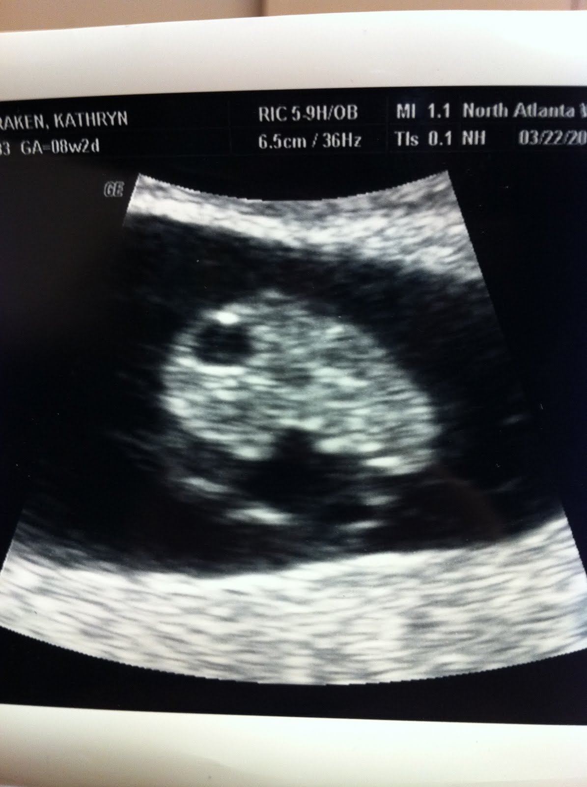 Healthy+heartbeat+at+11+weeks