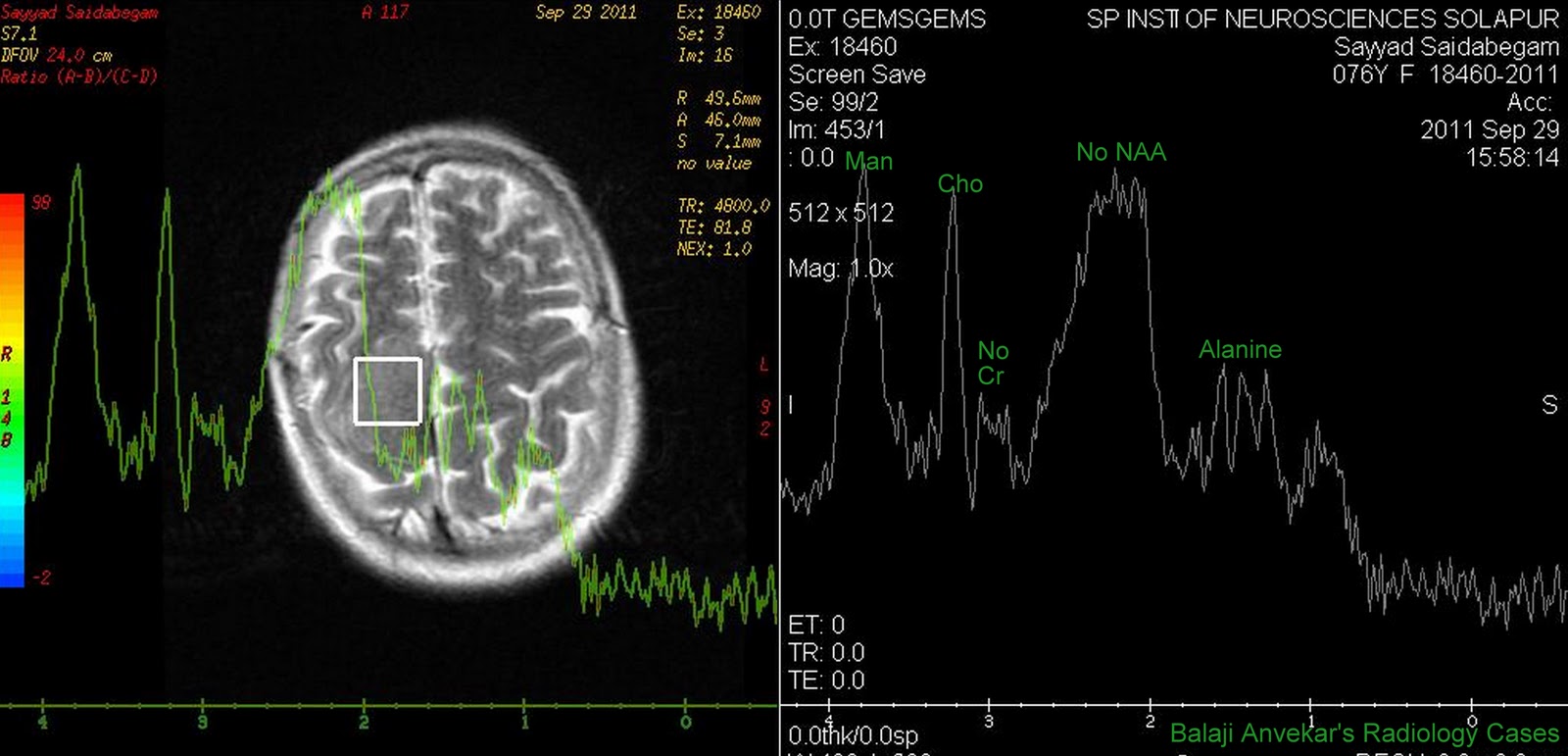 Dr Balaji Anvekar's Neuroradiology Cases Meningioma MR Spectroscopy