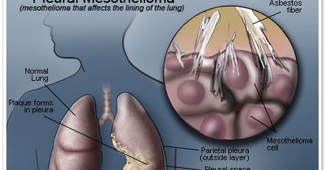 Asbestos Encapsulant Home Depot Natasyajungkel
