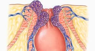 wasir obat herbal wasir