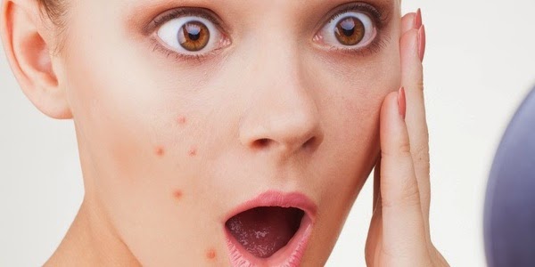 Cara Mengobati Jerawat Agar Tidak Menimbulkan Bekas Menghitam Cara Mengobati Jerawat Agar Tidak Menimbulkan Bekas Menghitam