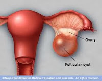 http://pengobatansinusitis01.blogspot.com/2013/11/pengobatan-kista-indung-telur.html