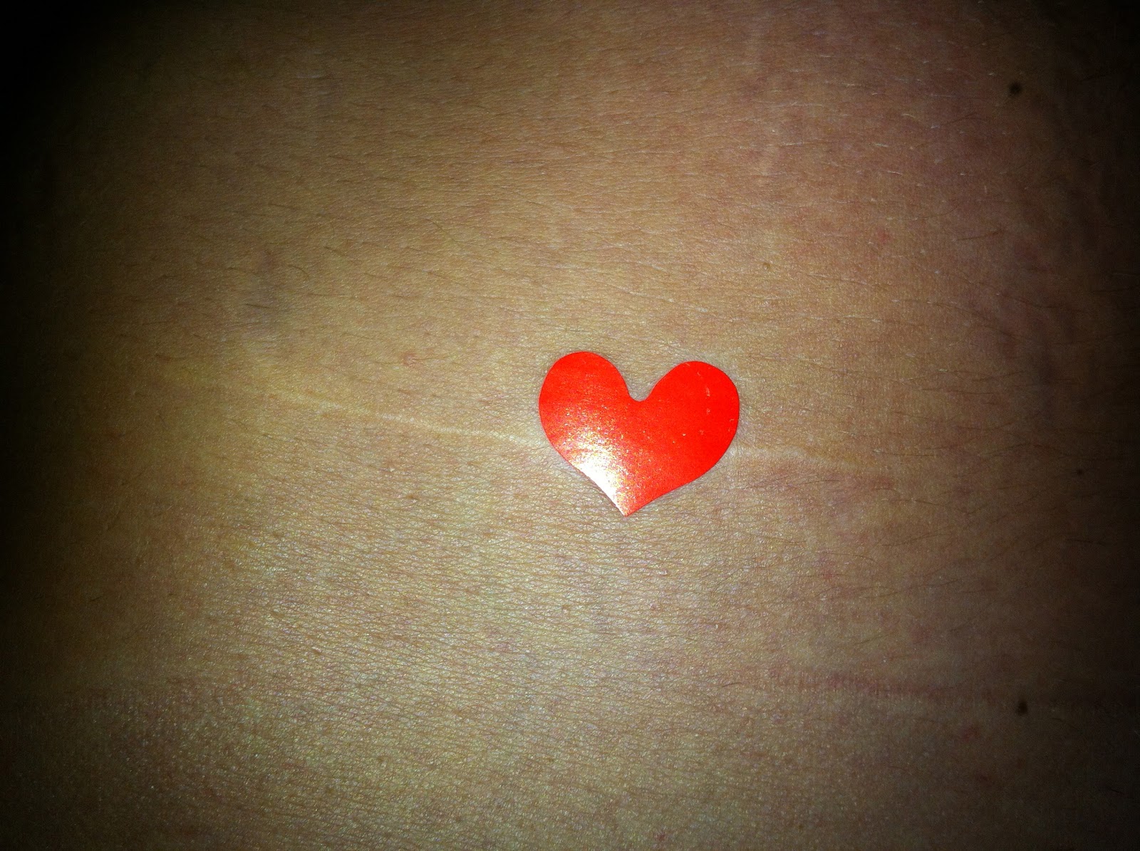 Appendix Removal Scar