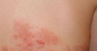 how long does it take to completely recover from shingles