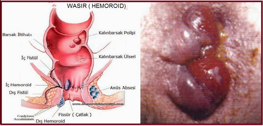 Image Obat hemorrhoid