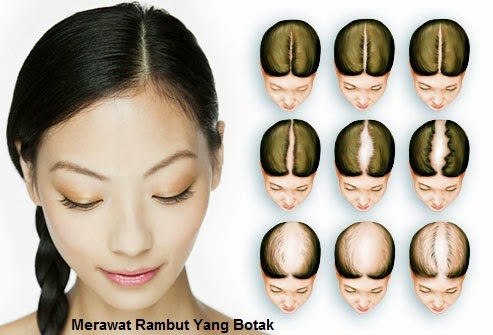 Menumbuhkan Rambut Menumbuhkan Rambut