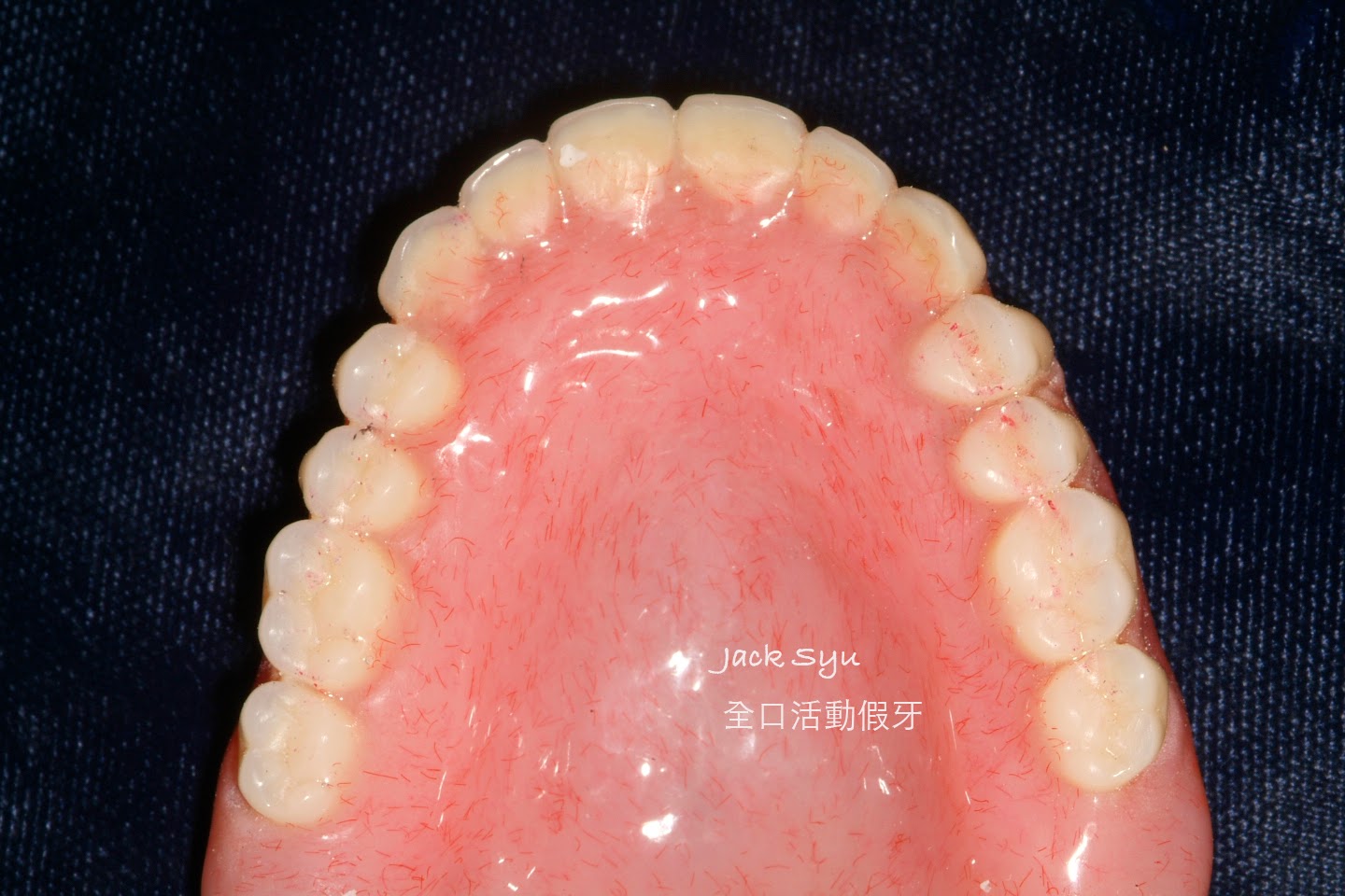 假牙種類｜全瓷冠、全鋯冠、固定假牙、活動假牙、微創齒雕 - 品味牙醫診所
