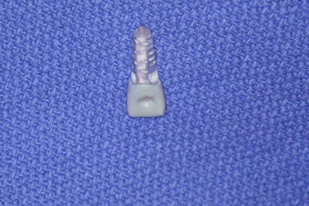 Dentistry Custom Cast Dowel Core