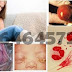 Ciri2 Terinfeksi Bakteri Neisseria Gonorrhoeae Pada Pria dan Wanita thumbnail