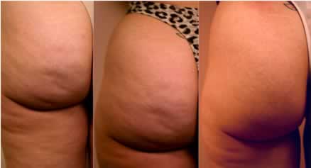 Cellulite Hold The Cottage Cheese Please For Health And Fitness