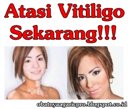 Obat Vitiligo Obat Vitiligo