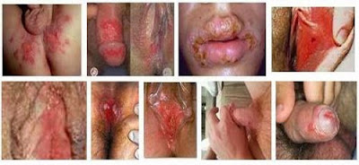 kutil kelamin kutil kelamin