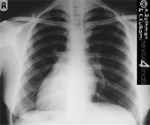 dextrocardia x ray