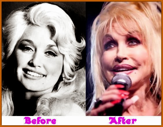 dolly parton plastic surgery
