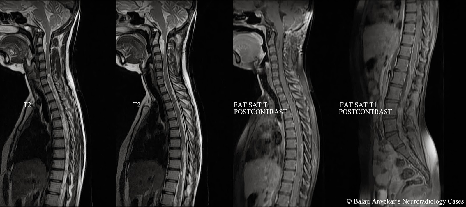 ct lumbar spine with iv contrast