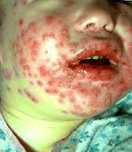 Penyakit Herpes Pada Anak Penyakit Herpes Pada Anak