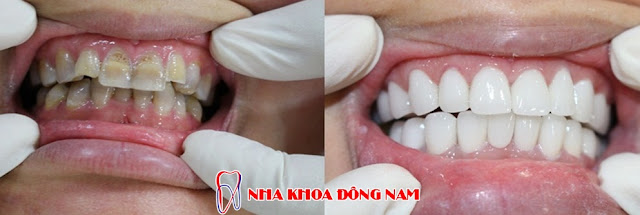 LÀM SAO ĐỂ RĂNG KHÔNG BỊ VÀNG 5 LÀM SAO ĐỂ RĂNG KHÔNG BỊ VÀNG 5