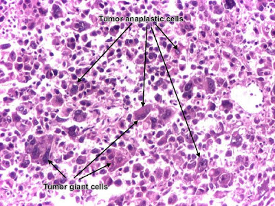 Histology and explanation of Poorly differentiated hepatocellular carcinoma