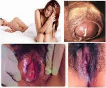Sebutkan Cara Pencegahan Penyakit Gonore Sebutkan Cara Pencegahan Penyakit Gonore