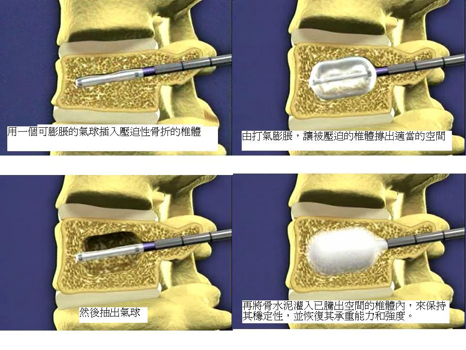 Balloon Pants Pictures Balloon Kyphoplasty