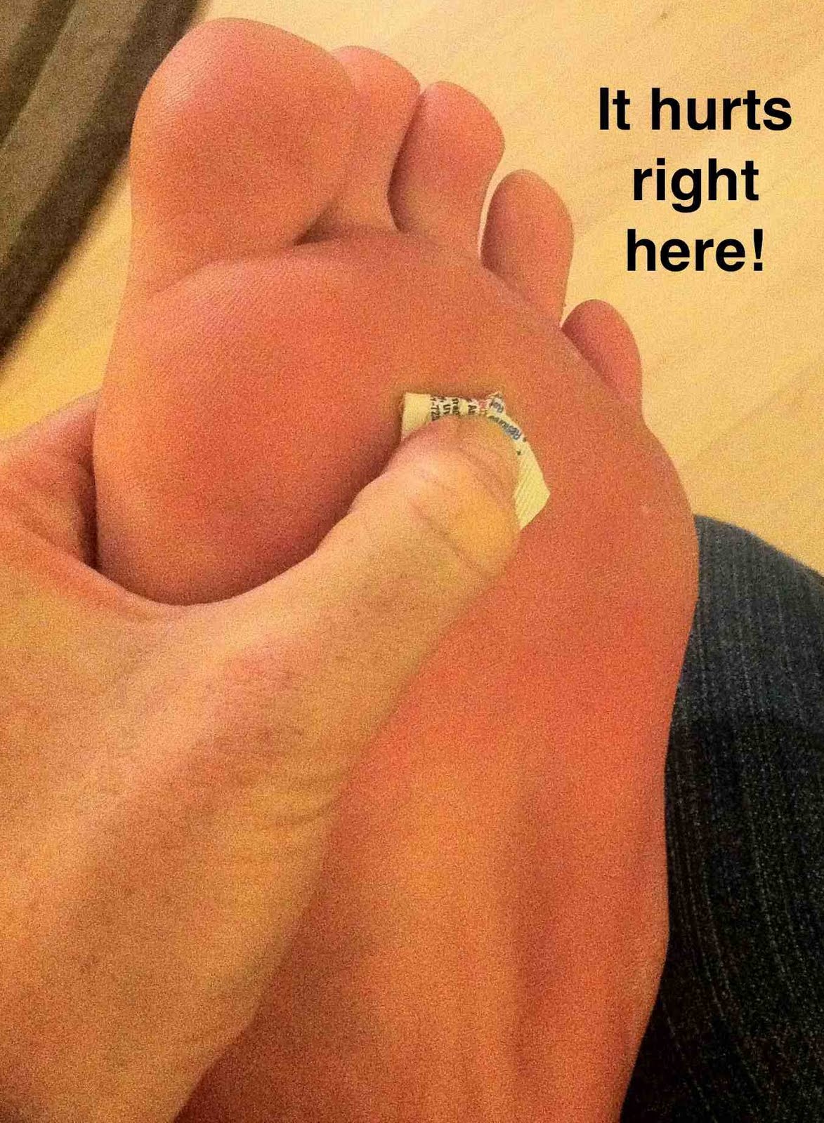 Hammertoe