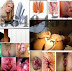 Penyakit Daging Yang Keluar Dari Lubang Dubur / Anus thumbnail