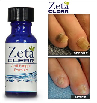 Zetaclear discount coupon