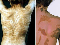 7 Penyakit kulit paling aneh di dunia