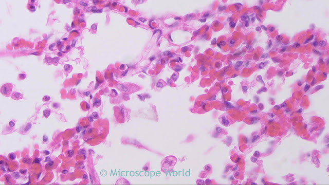 Microscopy image of pneumonia at 400x.